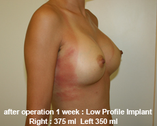 plastic-surgery-breast-augmentation